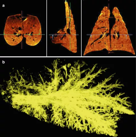 Functional Imaging Links Airway Structure to Inhaled Steroid Distribution in Severe Asthma